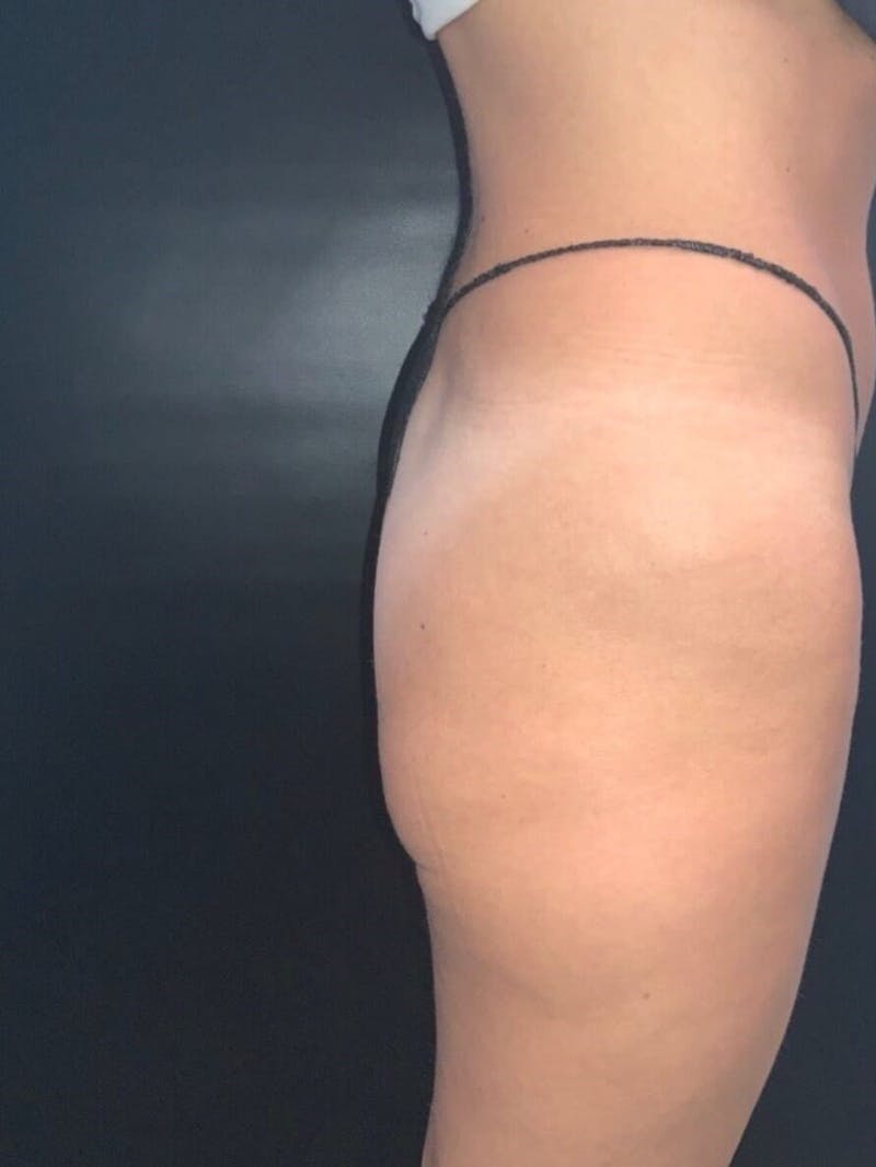 Buttocks Before & After Gallery - Patient 248079 - Image 1