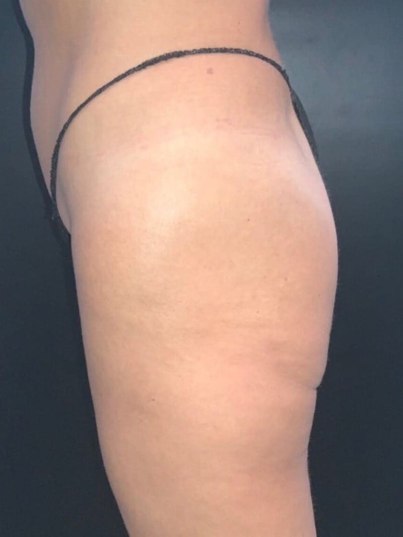 Buttocks Before & After Gallery - Patient 248079 - Image 3