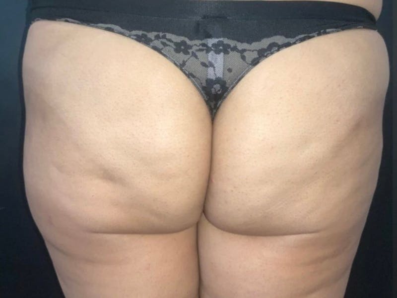 Buttocks Before & After Gallery - Patient 141500 - Image 1