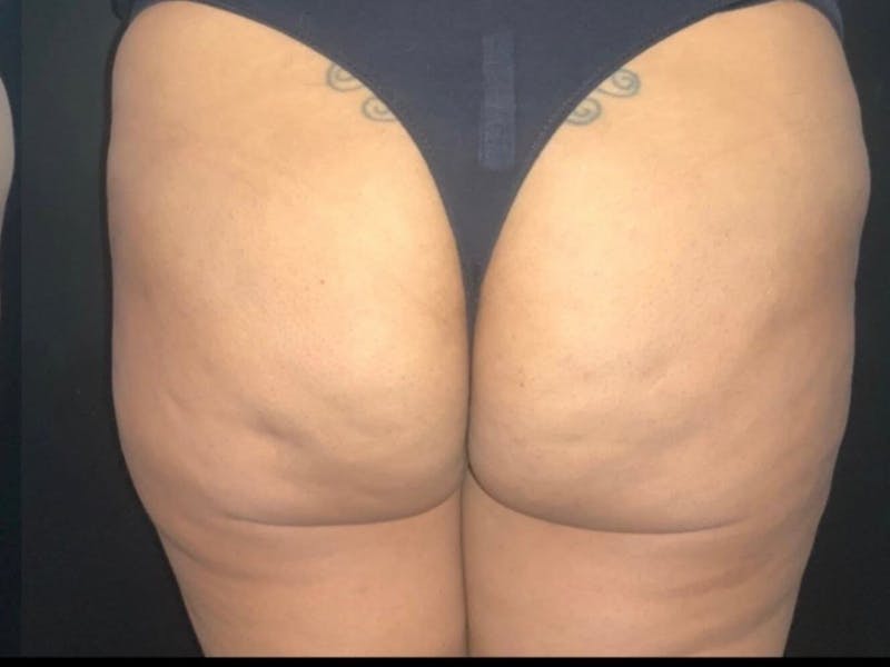 Buttocks Before & After Gallery - Patient 141500 - Image 2