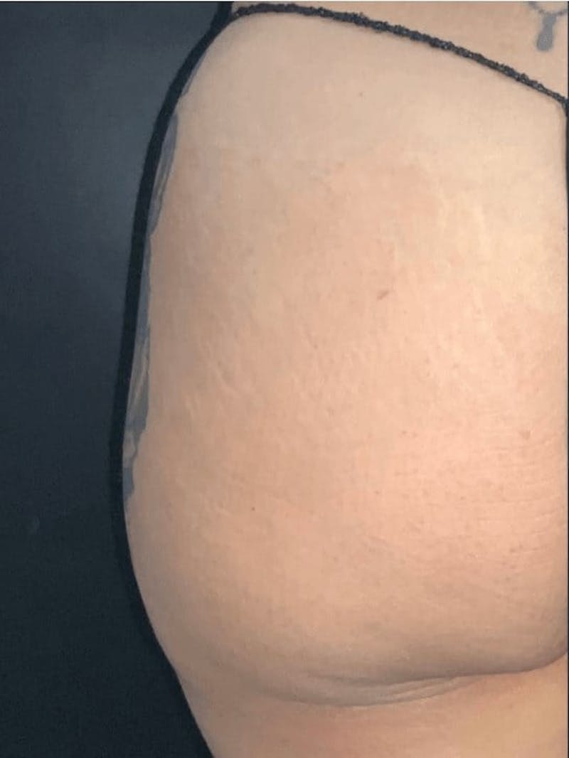 Buttocks Before & After Gallery - Patient 264547 - Image 1