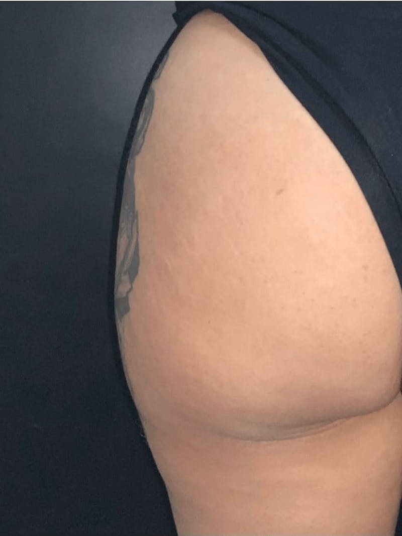 Buttocks Before & After Gallery - Patient 264547 - Image 2