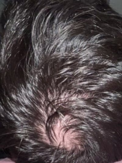 Hair Before & After Gallery - Patient 397542 - Image 1