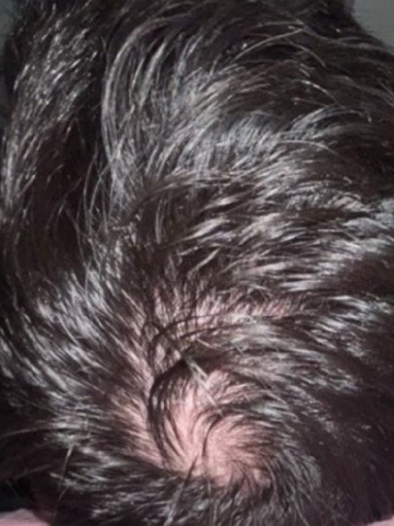 Hair Before & After Gallery - Patient 397542 - Image 1