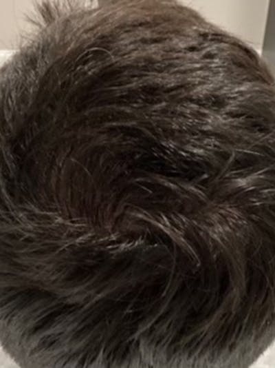 Hair Before & After Gallery - Patient 397542 - Image 2