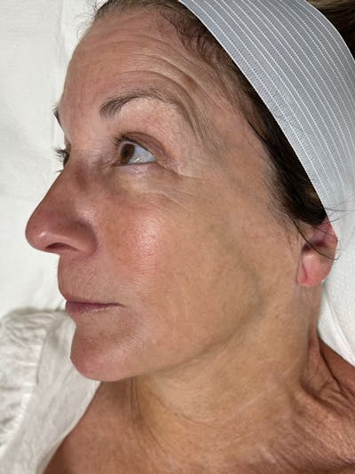Skin Before & After Gallery - Patient 329988 - Image 1