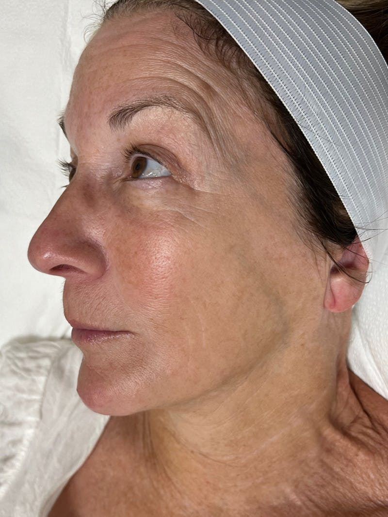 Skin Before & After Gallery - Patient 329988 - Image 1