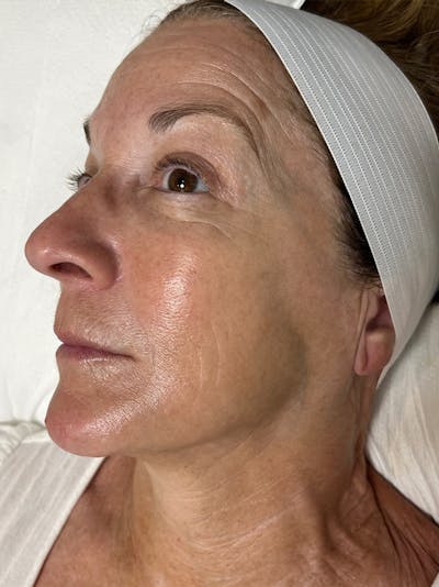 Skin Before & After Gallery - Patient 329988 - Image 2