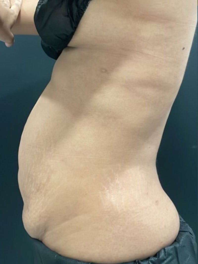 Body Before & After Gallery - Patient 161164 - Image 3
