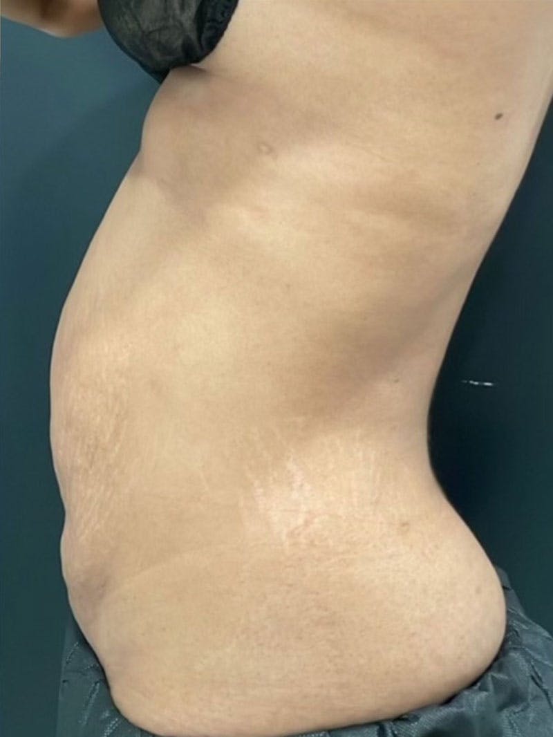 Body Before & After Gallery - Patient 161164 - Image 4