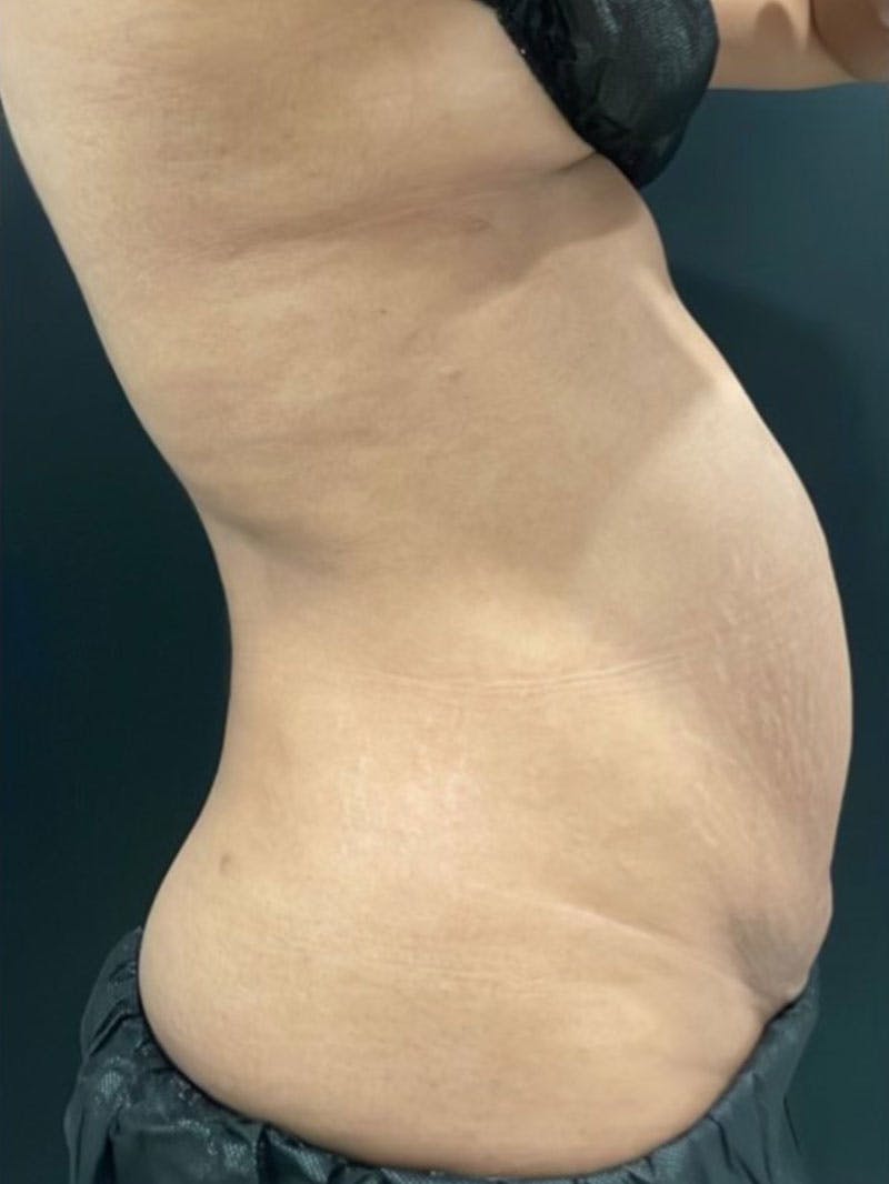 Body Before & After Gallery - Patient 161164 - Image 5