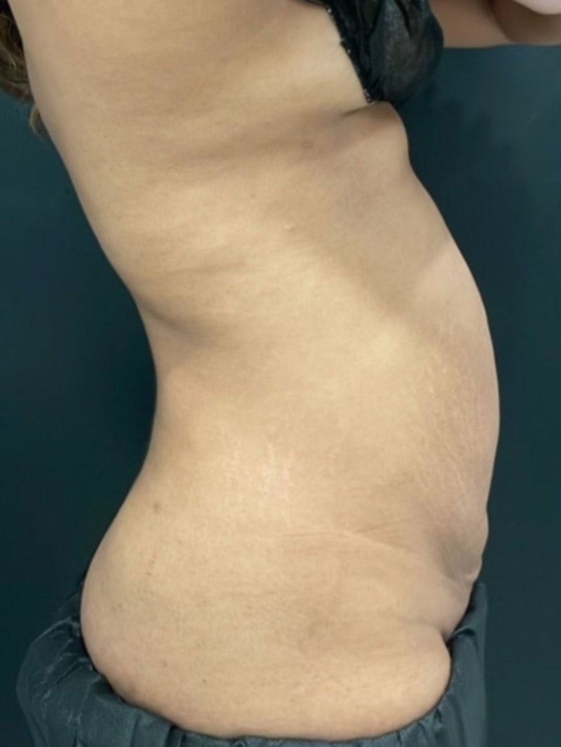 Body Before & After Gallery - Patient 161164 - Image 6