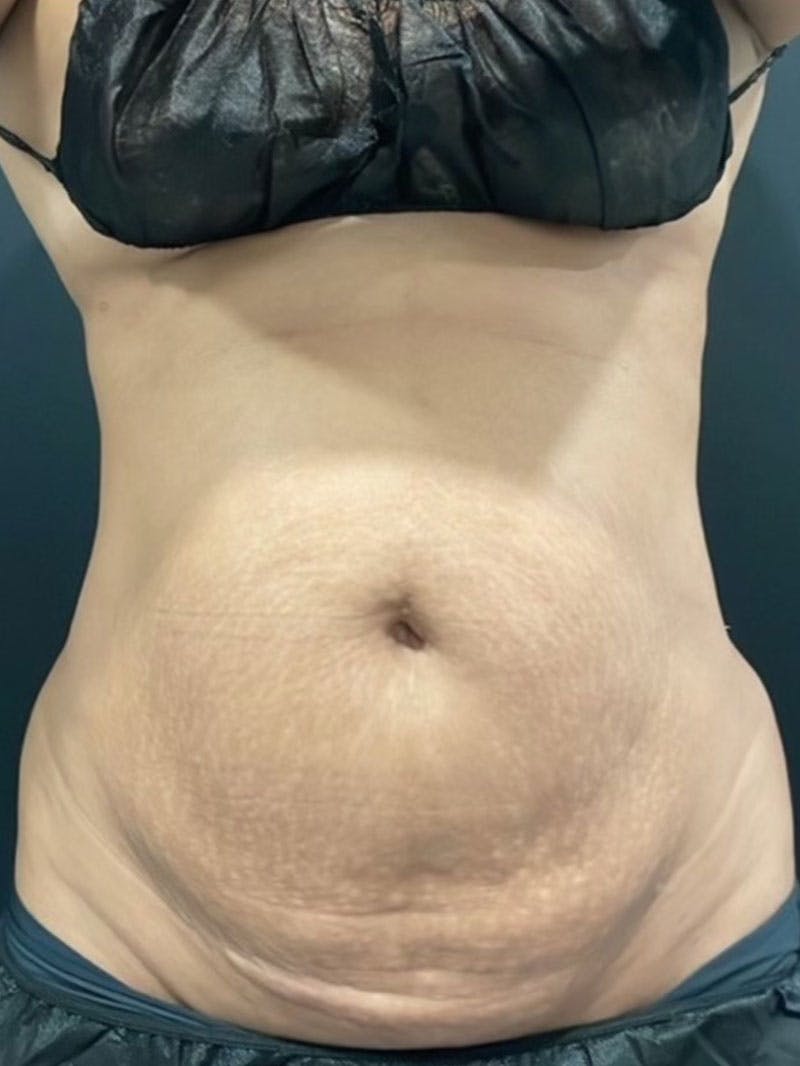 Body Before & After Gallery - Patient 161164 - Image 1