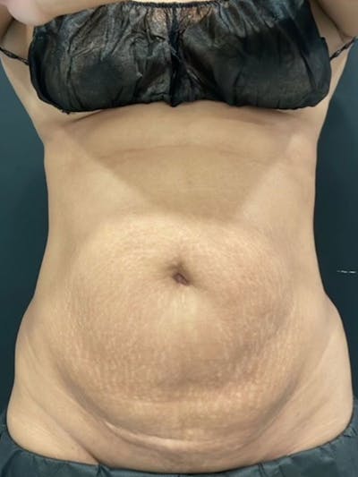 Body Before & After Gallery - Patient 161164 - Image 2