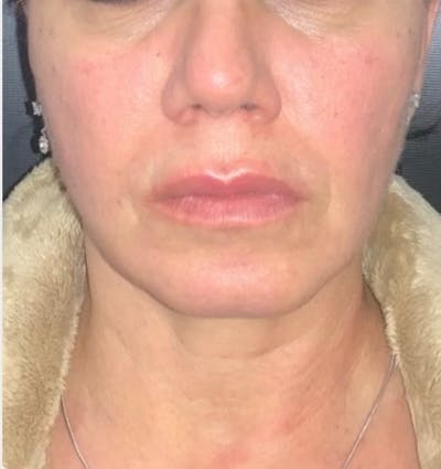 Face Before & After Gallery - Patient 156623 - Image 1