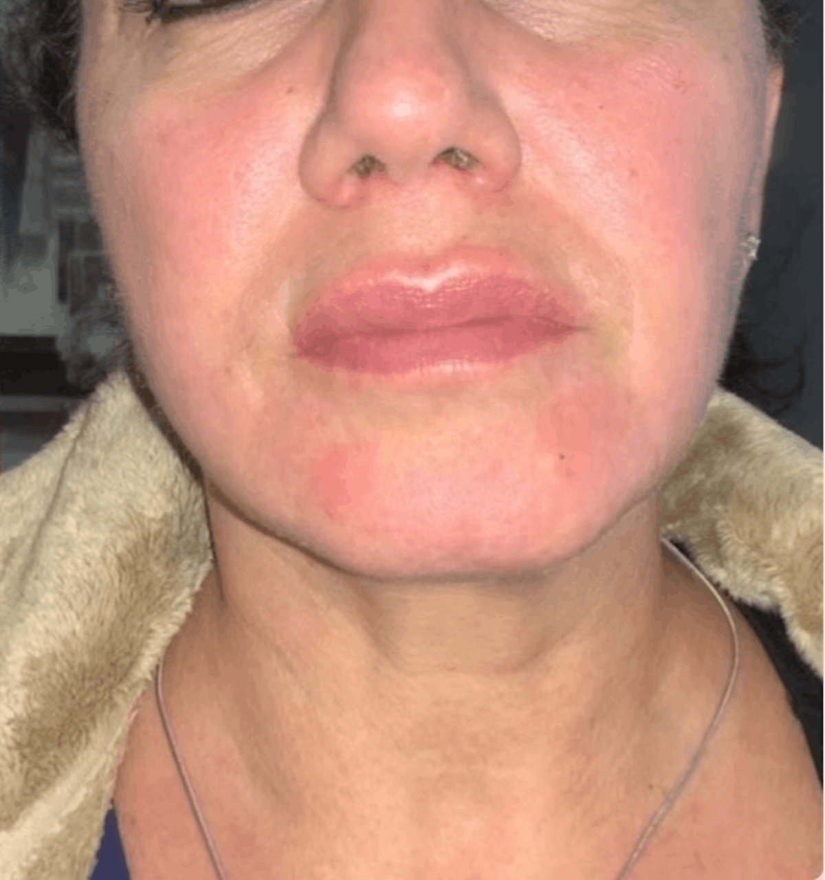 Face Before & After Gallery - Patient 156623 - Image 2
