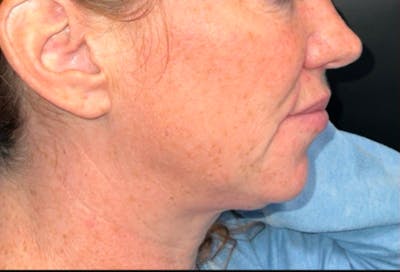 Face Before & After Gallery - Patient 242205 - Image 1