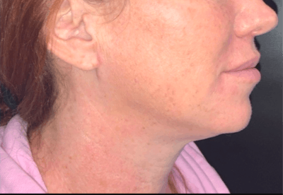 Face Before & After Gallery - Patient 242205 - Image 2