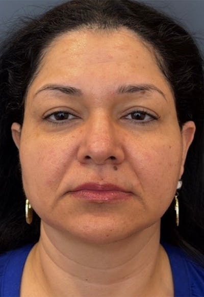 Face Before & After Gallery - Patient 415747 - Image 2