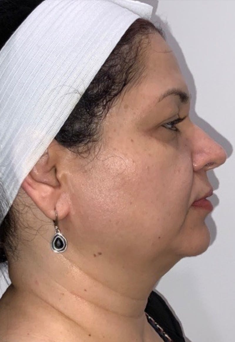 Face Before & After Gallery - Patient 415747 - Image 3
