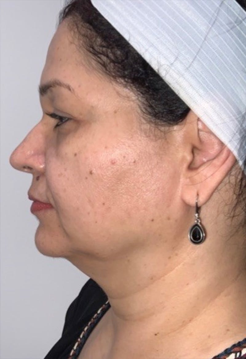 Face Before & After Gallery - Patient 415747 - Image 5