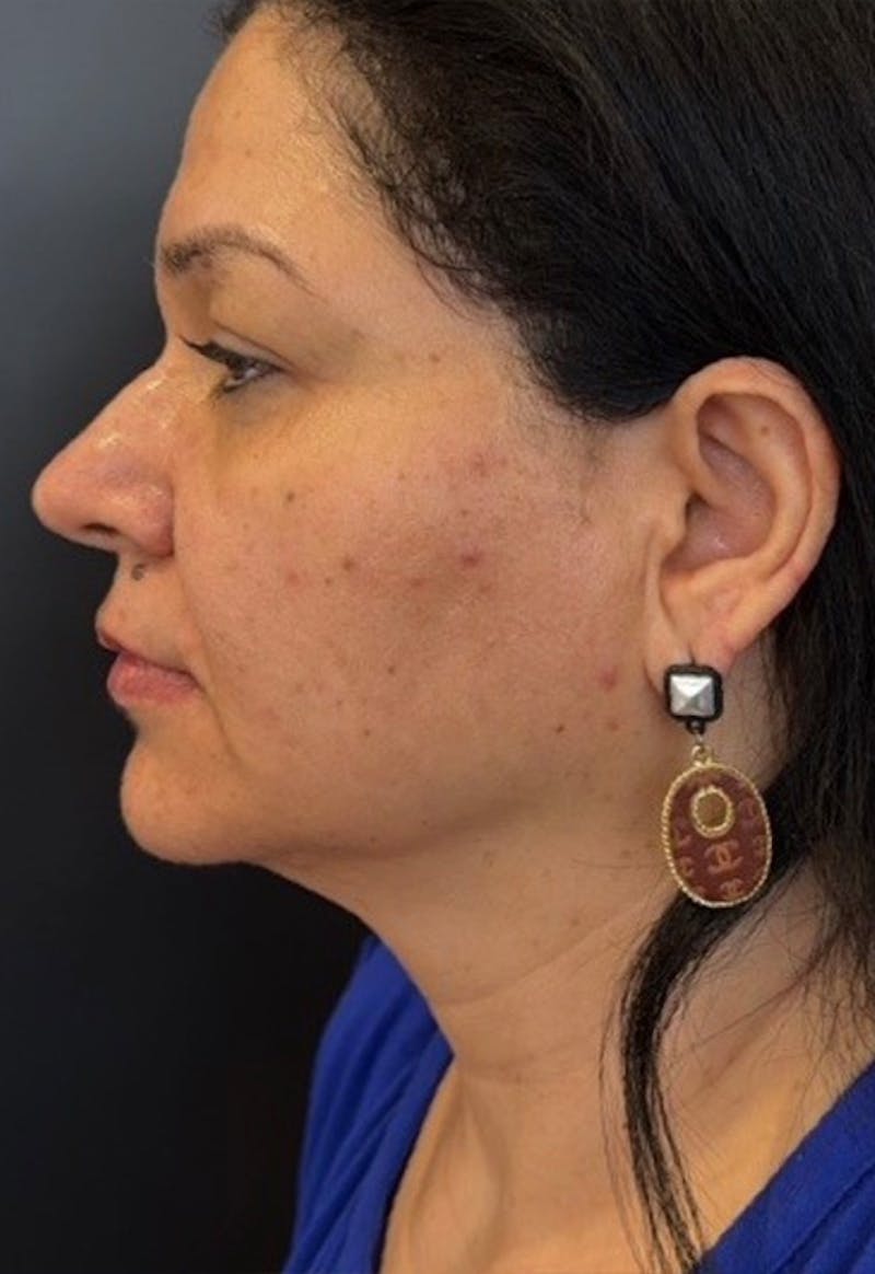Face Before & After Gallery - Patient 415747 - Image 6