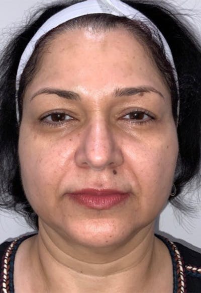 Face Before & After Gallery - Patient 415747 - Image 1