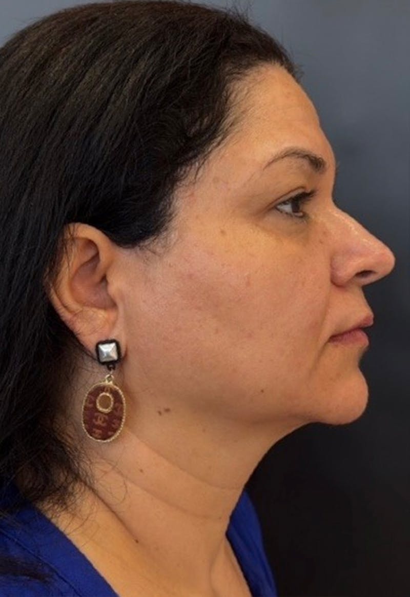 Face Before & After Gallery - Patient 415747 - Image 4