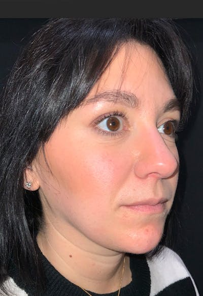 Face Before & After Gallery - Patient 170206 - Image 2
