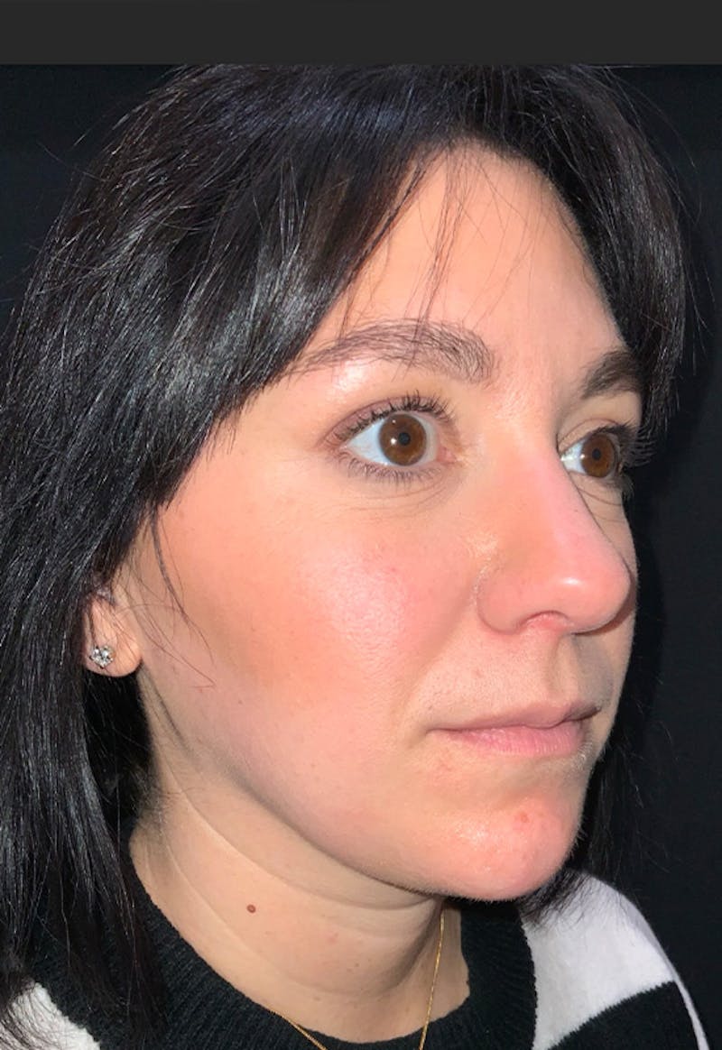 Face Before & After Gallery - Patient 170206 - Image 2