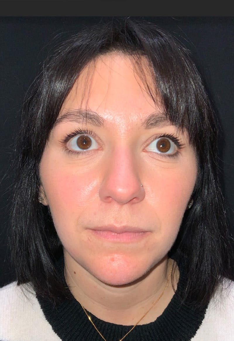 Face Before & After Gallery - Patient 170206 - Image 4