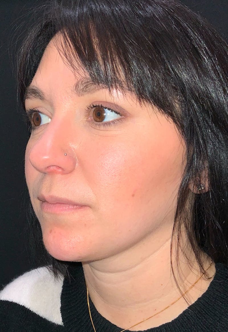 Face Before & After Gallery - Patient 170206 - Image 6