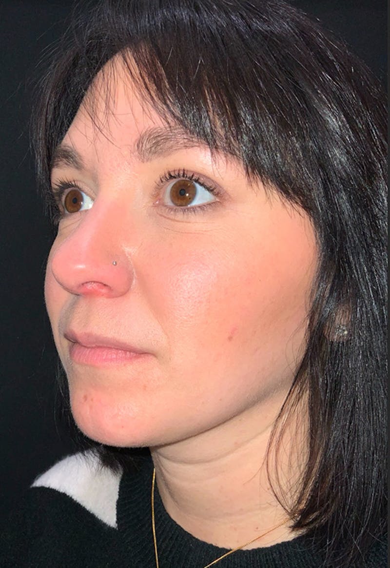 Face Before & After Gallery - Patient 170206 - Image 5