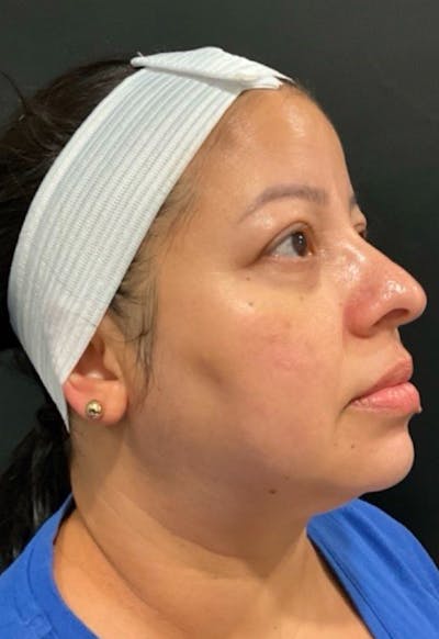Skin Before & After Gallery - Patient 406591 - Image 2