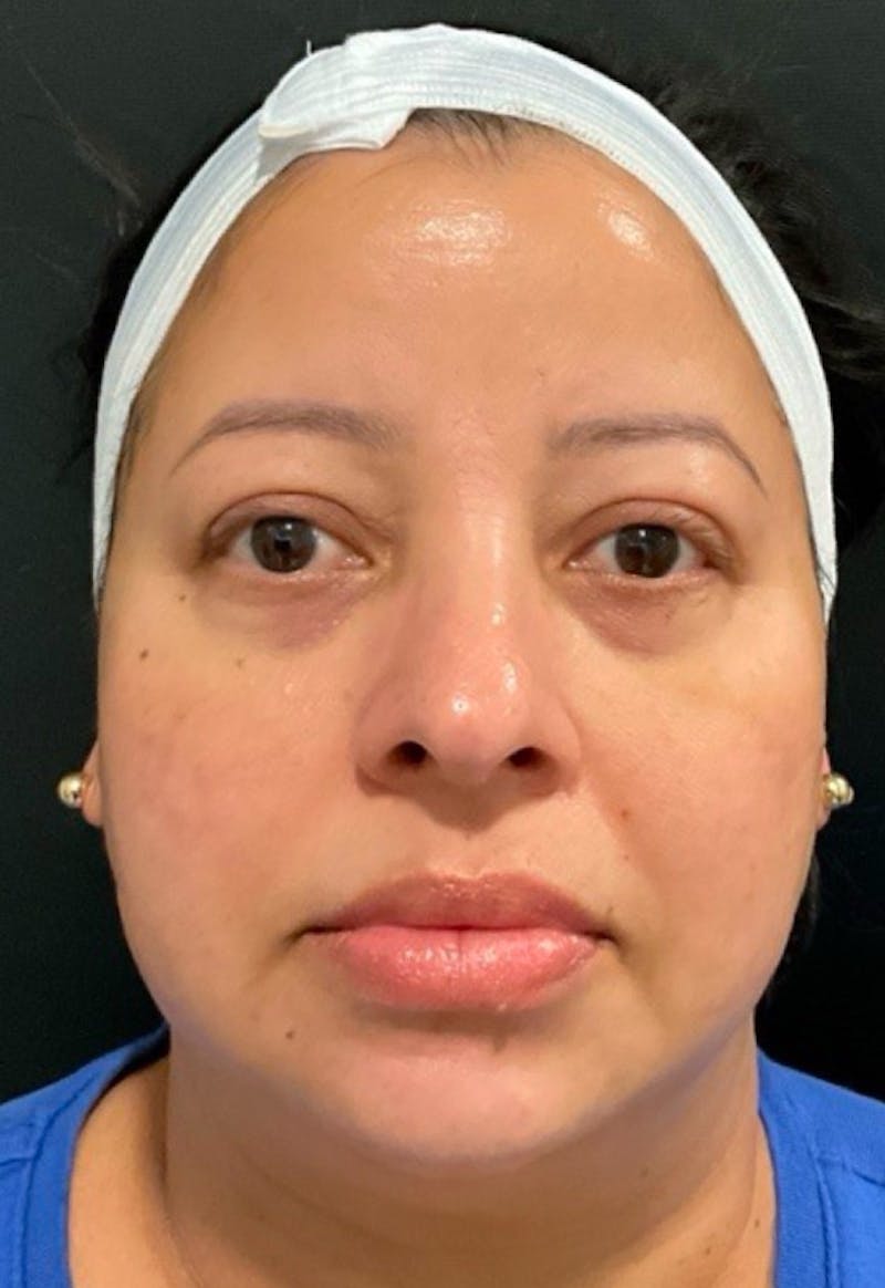 Skin Before & After Gallery - Patient 406591 - Image 4