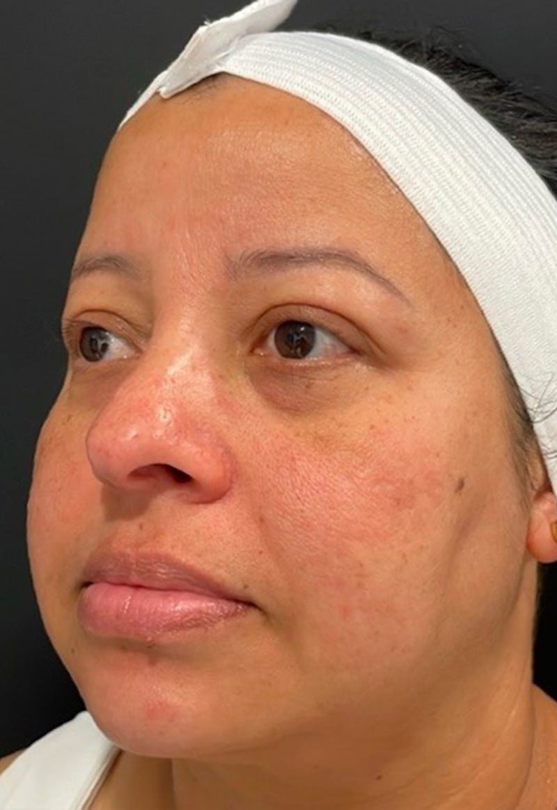 Skin Before & After Gallery - Patient 406591 - Image 5