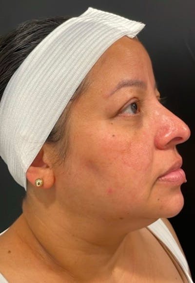 Skin Before & After Gallery - Patient 406591 - Image 1