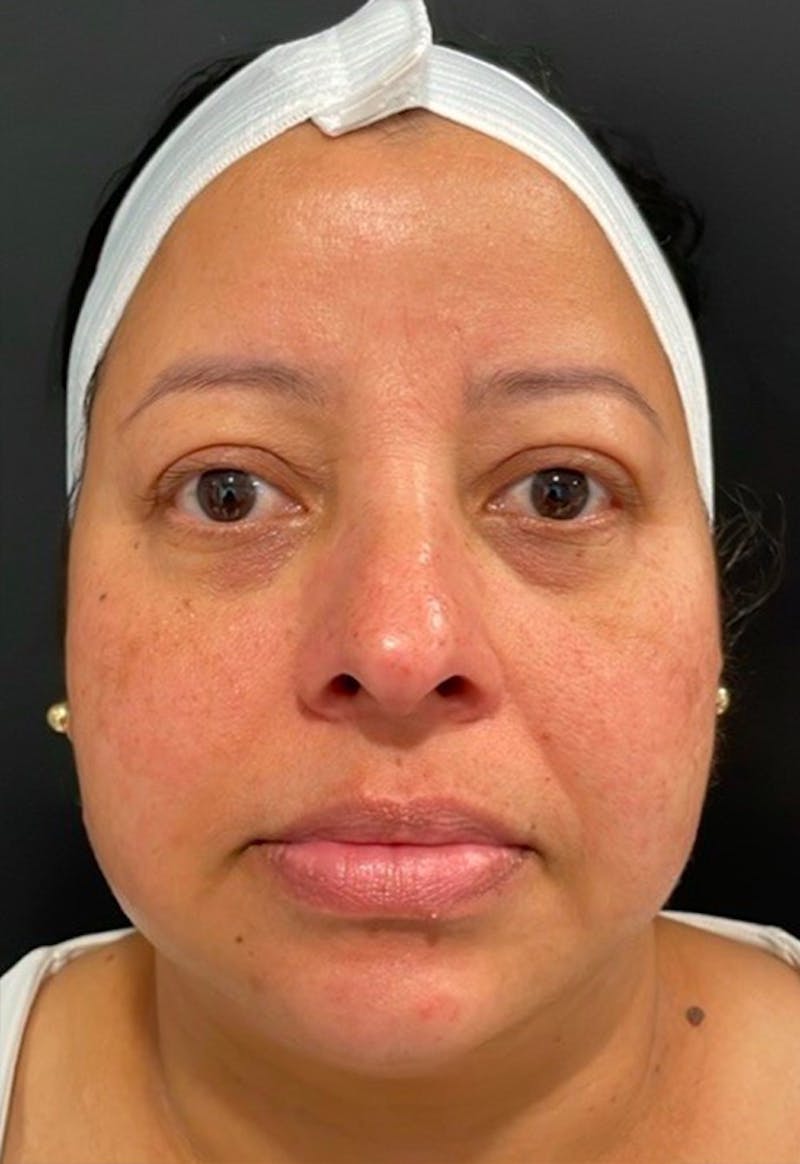 Skin Before & After Gallery - Patient 406591 - Image 3
