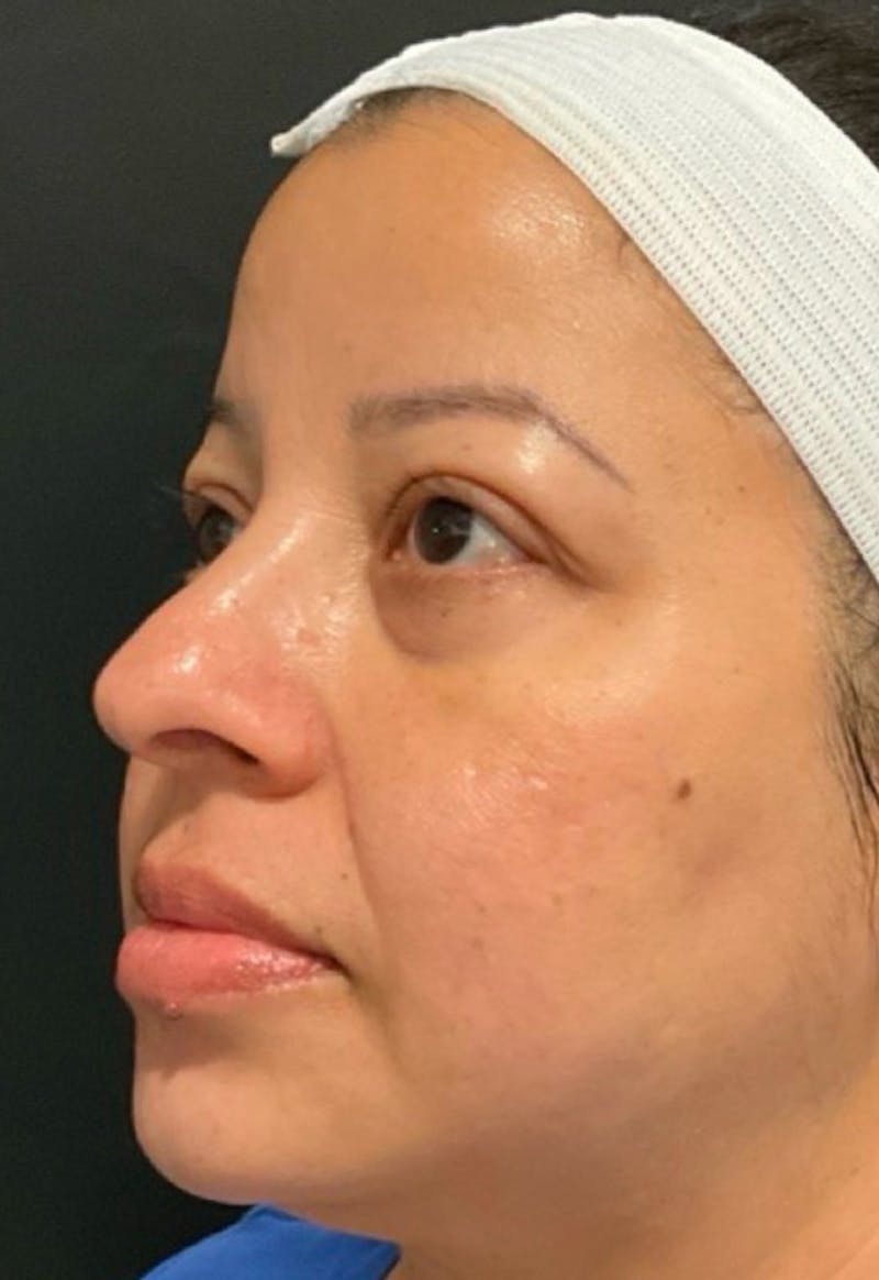 Skin Before & After Gallery - Patient 406591 - Image 6