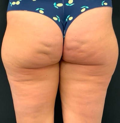Body Before & After Gallery - Patient 252839 - Image 1