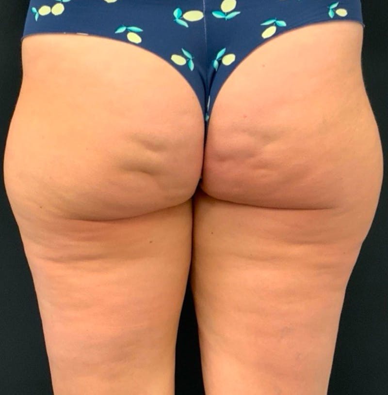 Body Before & After Gallery - Patient 252839 - Image 1