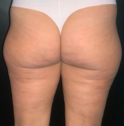 Body Before & After Gallery - Patient 252839 - Image 2