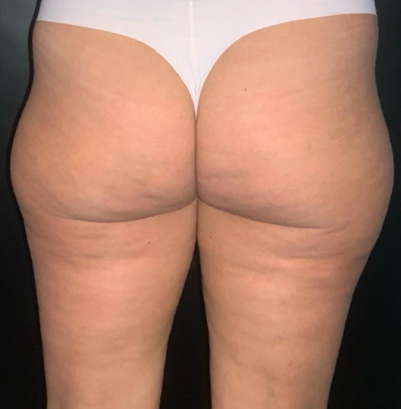 Body Before & After Gallery - Patient 252839 - Image 2