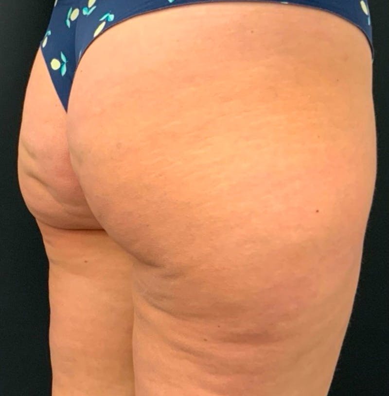 Body Before & After Gallery - Patient 252839 - Image 5