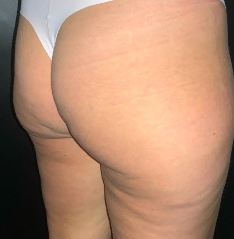 Body Before & After Gallery - Patient 252839 - Image 6