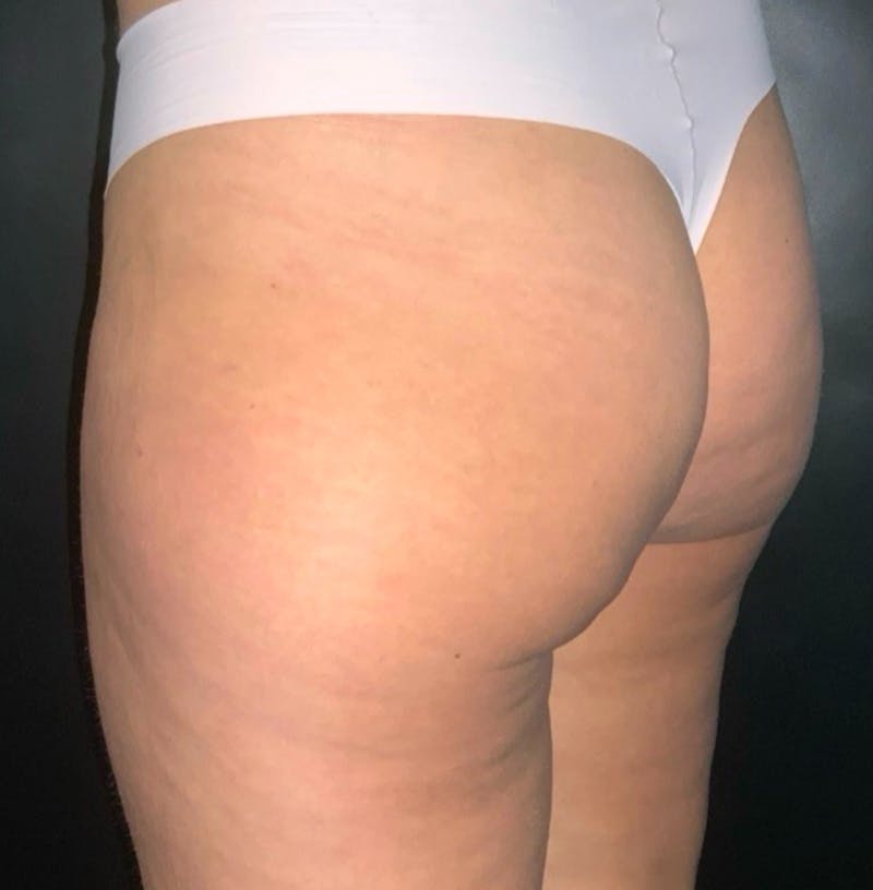 Body Before & After Gallery - Patient 252839 - Image 4