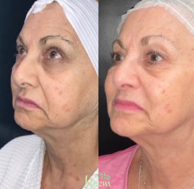 Face Before & After Gallery - Patient 354067 - Image 1