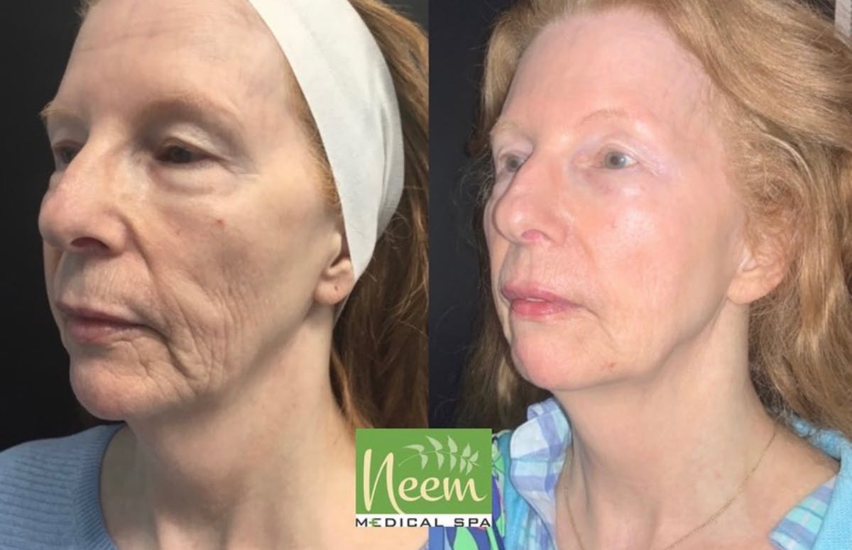 Face Before & After Gallery - Patient 456167 - Image 1