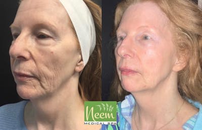 Face Before & After Gallery - Patient 456167 - Image 1