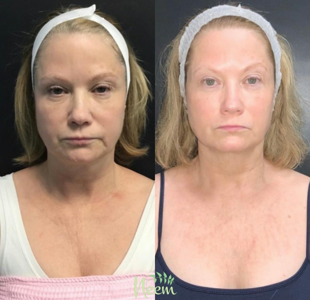 Face Before & After Gallery - Patient 962183 - Image 1